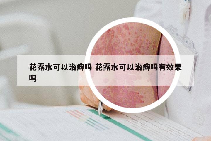 花露水可以治癣吗 花露水可以治癣吗有效果吗