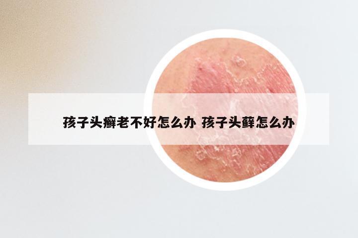 孩子头癣老不好怎么办 孩子头藓怎么办