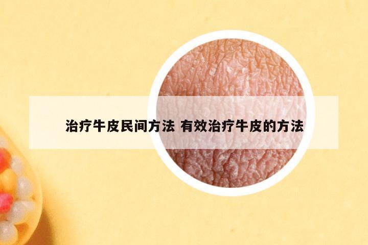 治疗牛皮民间方法 有效治疗牛皮的方法