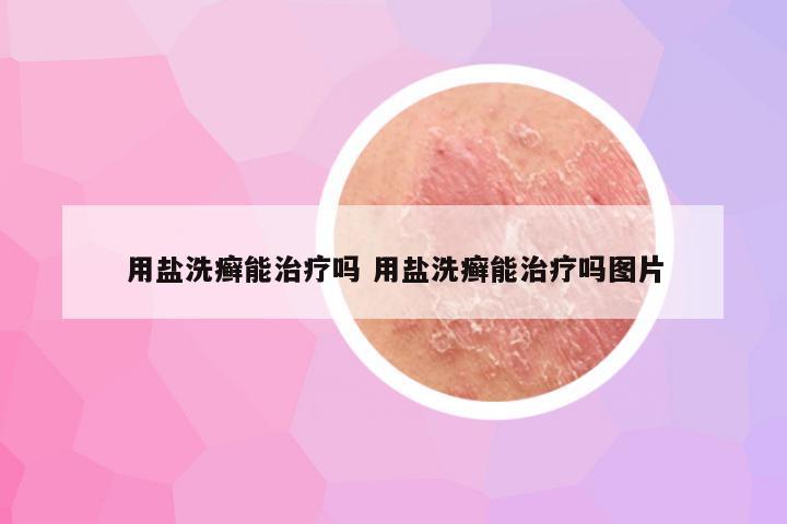 用盐洗癣能治疗吗 用盐洗癣能治疗吗图片