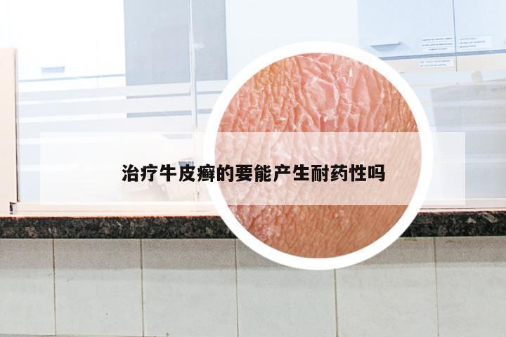 治疗牛皮癣的要能产生耐药性吗