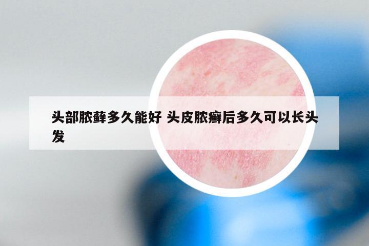 头部脓藓多久能好 头皮脓癣后多久可以长头发