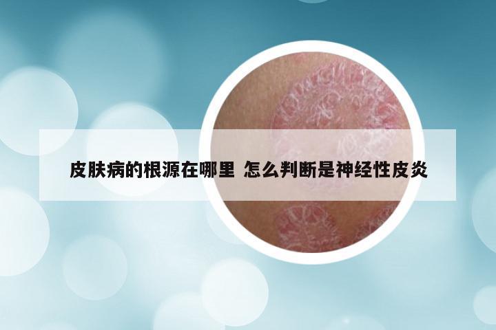 皮肤病的根源在哪里 怎么判断是神经性皮炎
