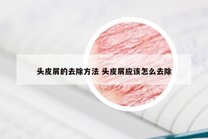 头皮屑的去除方法 头皮屑应该怎么去除