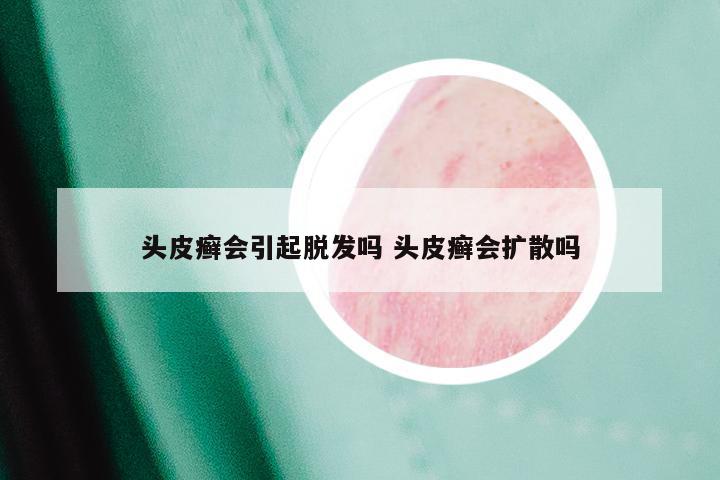头皮癣会引起脱发吗 头皮癣会扩散吗