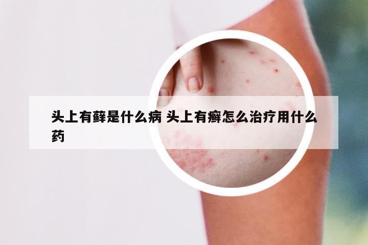 头上有藓是什么病 头上有癣怎么治疗用什么药