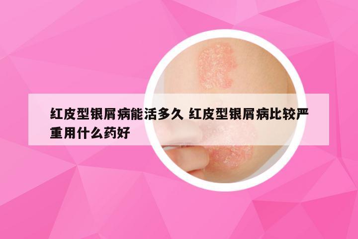 红皮型银屑病能活多久 红皮型银屑病比较严重用什么药好