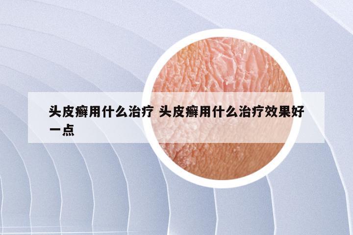 头皮癣用什么治疗 头皮癣用什么治疗效果好一点