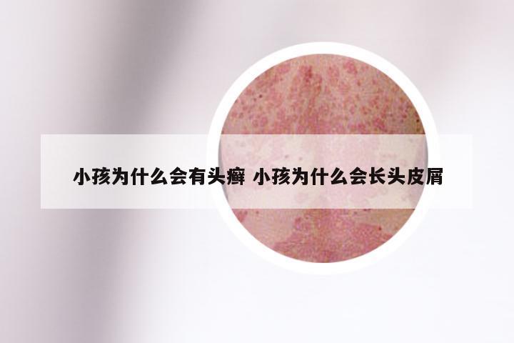 小孩为什么会有头癣 小孩为什么会长头皮屑