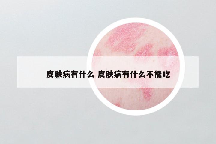 皮肤病有什么 皮肤病有什么不能吃