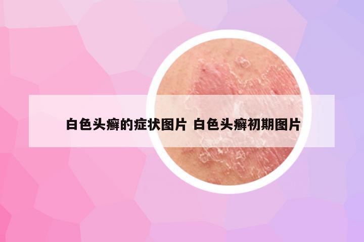 白色头癣的症状图片 白色头癣初期图片