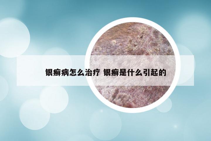 银癣病怎么治疗 银癣是什么引起的