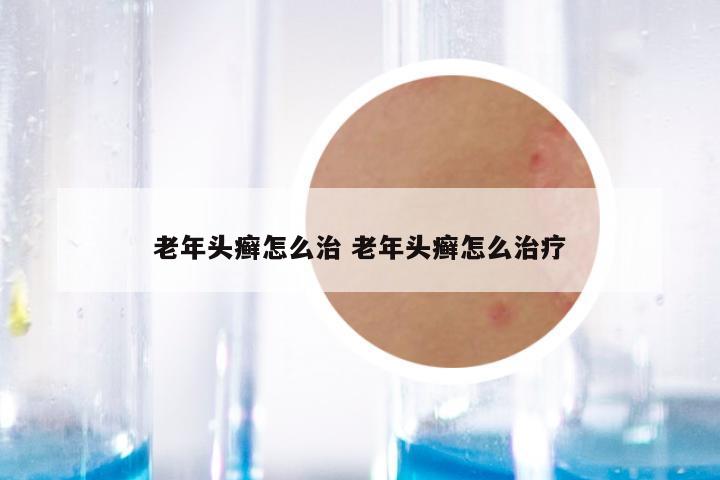 老年头癣怎么治 老年头癣怎么治疗