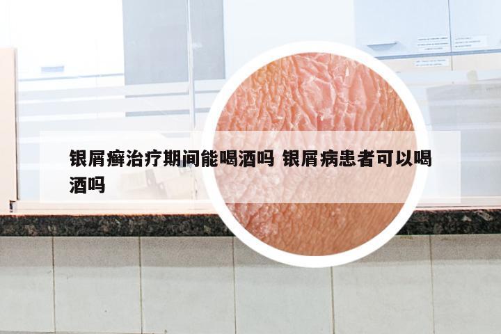 银屑癣治疗期间能喝酒吗 银屑病患者可以喝酒吗