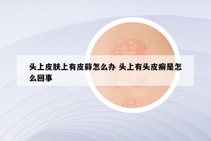 头上皮肤上有皮藓怎么办 头上有头皮癣是怎么回事