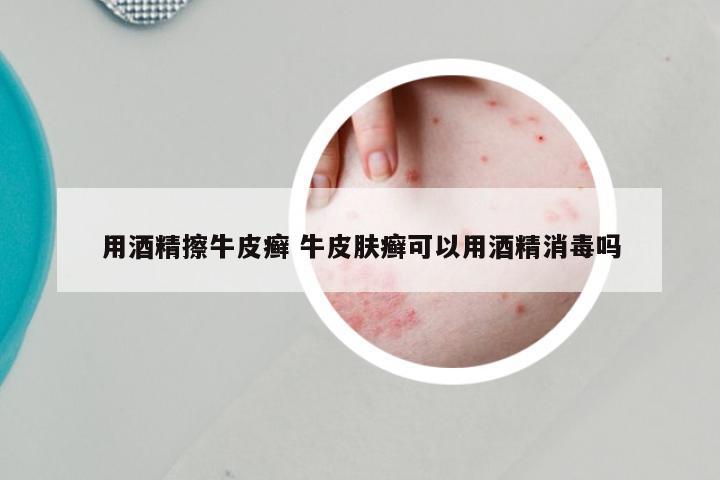 用酒精擦牛皮癣 牛皮肤癣可以用酒精消毒吗