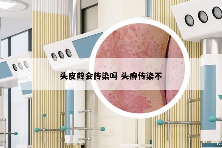头皮藓会传染吗 头癣传染不
