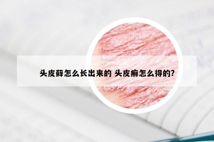 头皮藓怎么长出来的 头皮癣怎么得的?