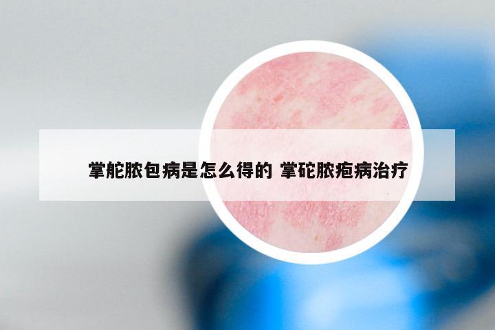 掌舵脓包病是怎么得的 掌砣脓疱病治疗