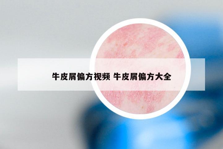 牛皮屑偏方视频 牛皮屑偏方大全