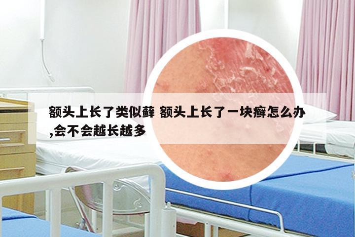 额头上长了类似藓 额头上长了一块癣怎么办,会不会越长越多