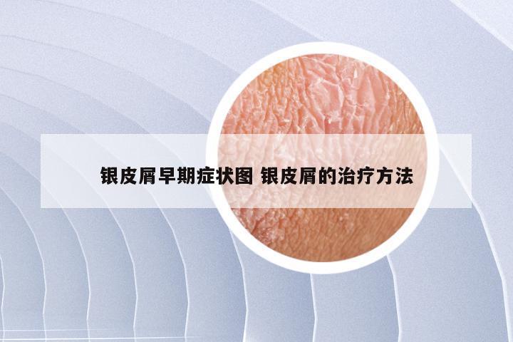 银皮屑早期症状图 银皮屑的治疗方法