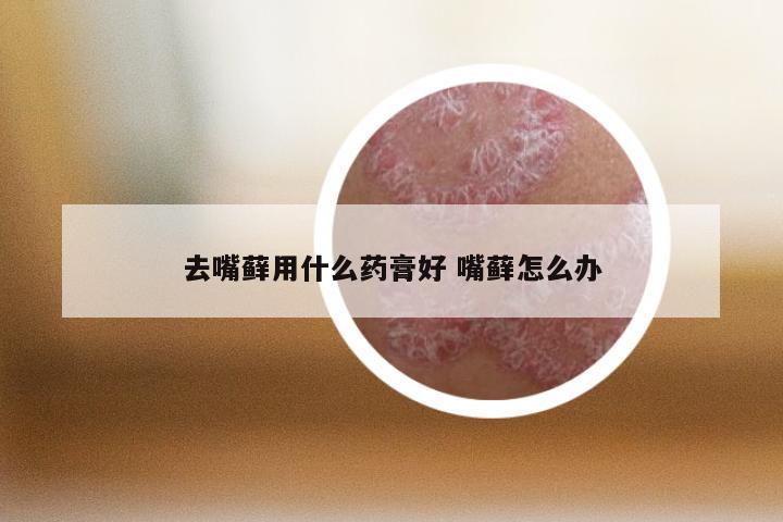 去嘴藓用什么药膏好 嘴藓怎么办