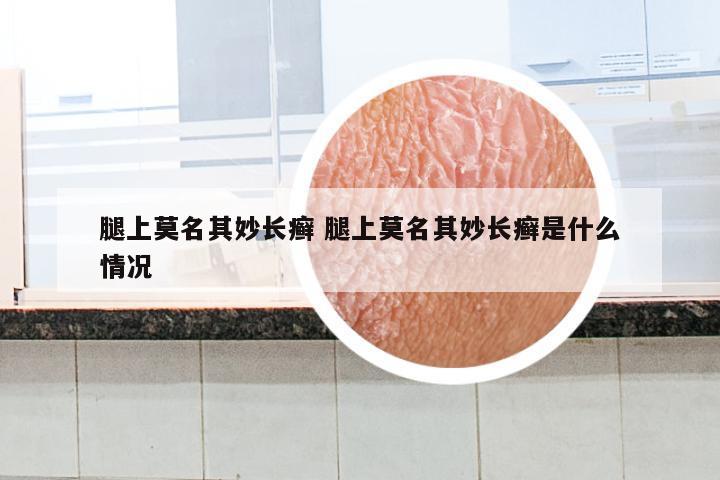 腿上莫名其妙长癣 腿上莫名其妙长癣是什么情况