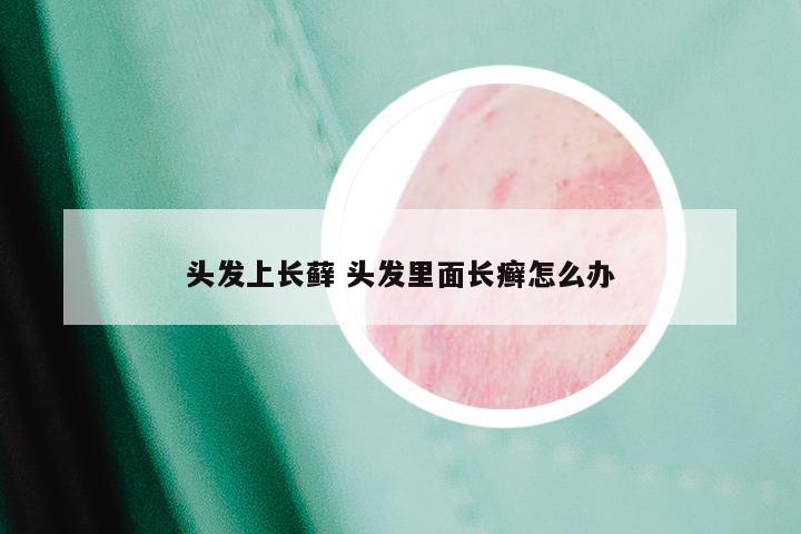 头发上长藓 头发里面长癣怎么办