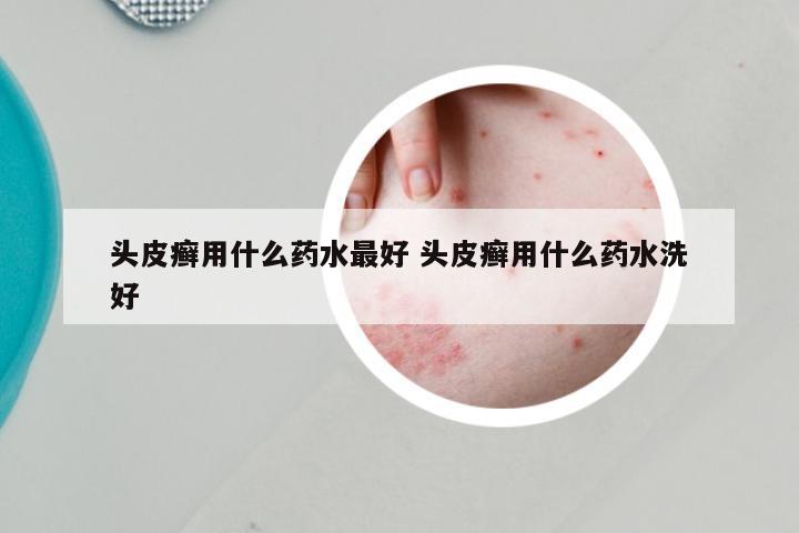 头皮癣用什么药水最好 头皮癣用什么药水洗好