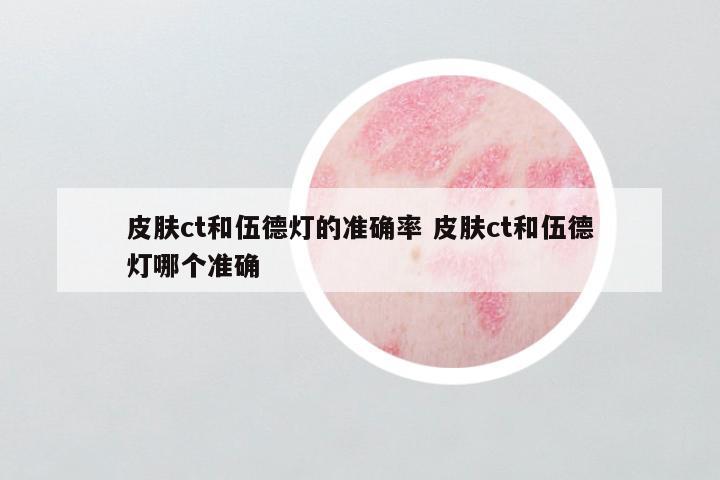 皮肤ct和伍德灯的准确率 皮肤ct和伍德灯哪个准确