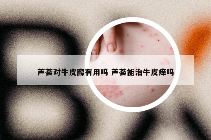 芦荟对牛皮廨有用吗 芦荟能治牛皮痒吗