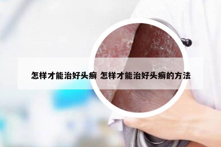 怎样才能治好头癣 怎样才能治好头癣的方法