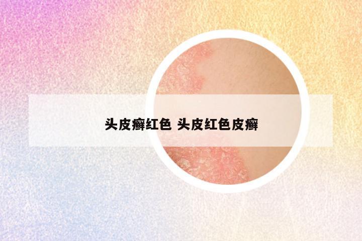 头皮癣红色 头皮红色皮癣