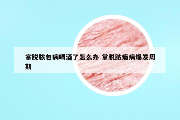 掌脱脓包病喝酒了怎么办 掌脱脓疱病爆发周期