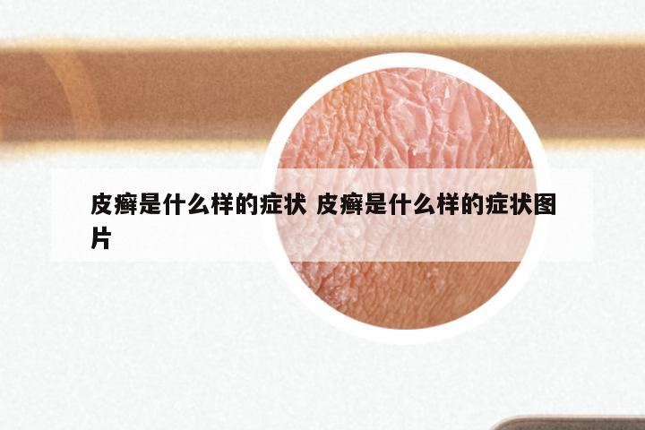 皮癣是什么样的症状 皮癣是什么样的症状图片