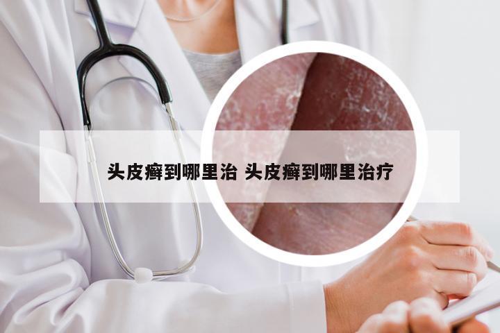 头皮癣到哪里治 头皮癣到哪里治疗