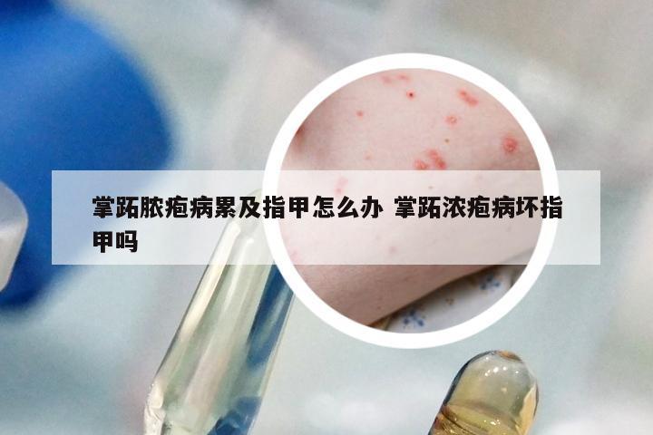 掌跖脓疱病累及指甲怎么办 掌跖浓疱病坏指甲吗