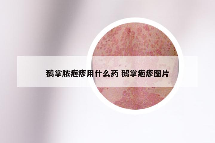 鹅掌脓疱疹用什么药 鹅掌疱疹图片