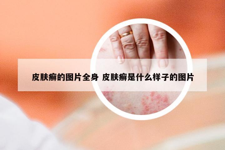 皮肤癣的图片全身 皮肤癣是什么样子的图片