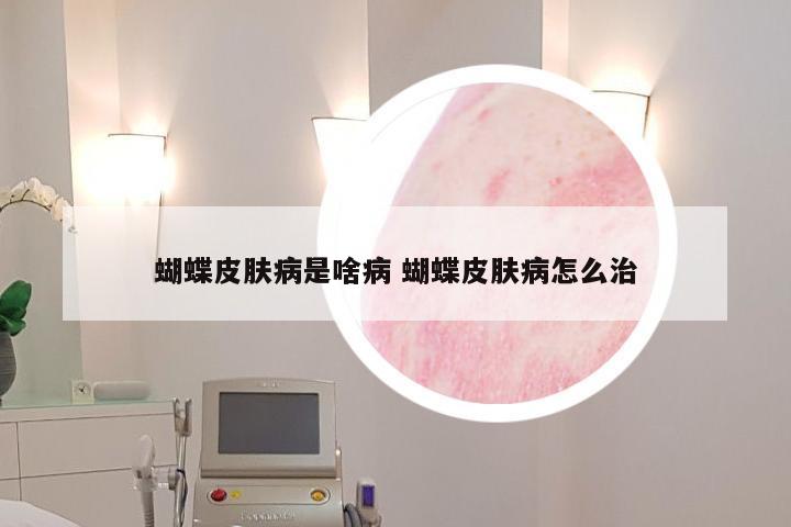 蝴蝶皮肤病是啥病 蝴蝶皮肤病怎么治