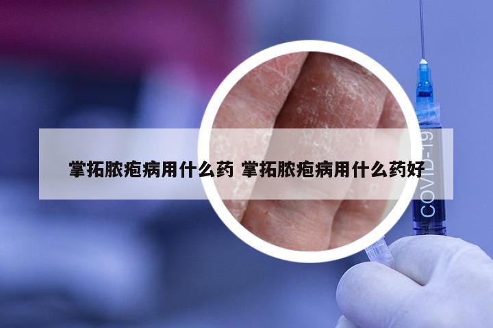 掌拓脓疱病用什么药 掌拓脓疱病用什么药好