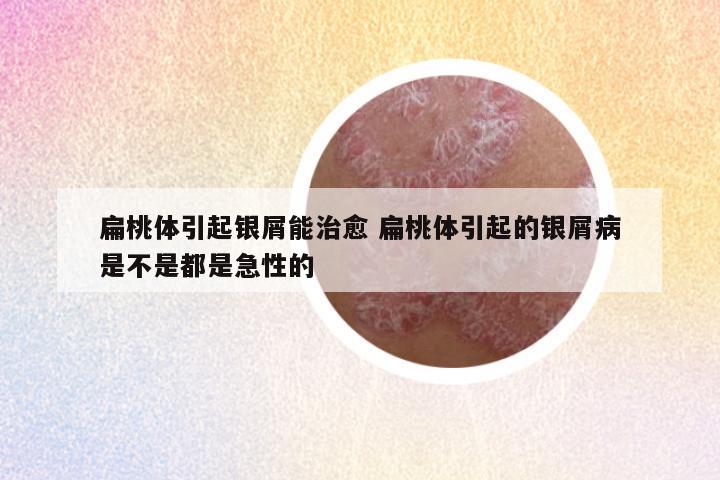 扁桃体引起银屑能治愈 扁桃体引起的银屑病是不是都是急性的