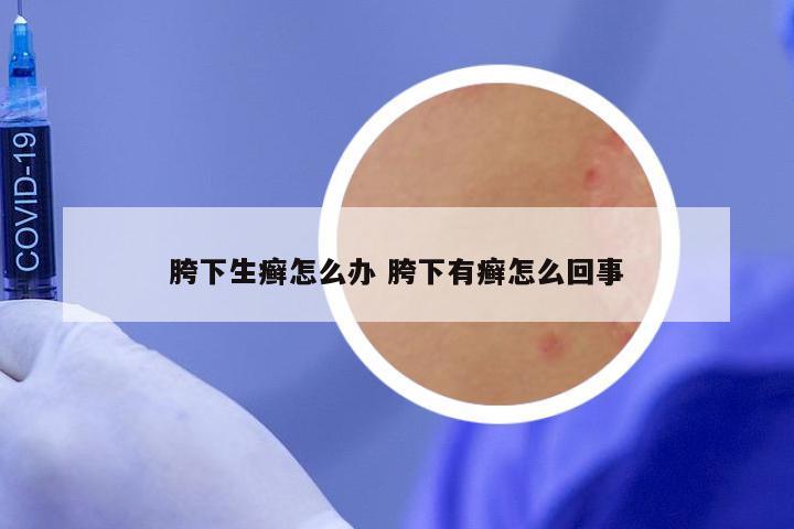 胯下生癣怎么办 胯下有癣怎么回事