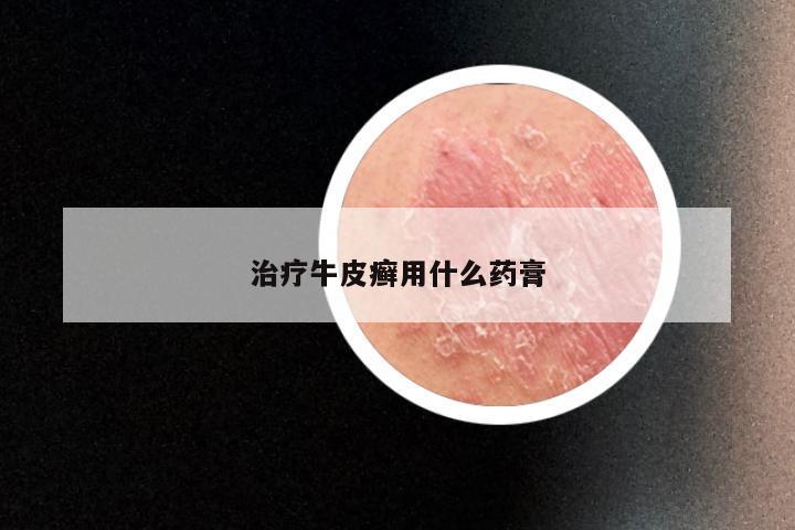 治疗牛皮癣用什么药膏
