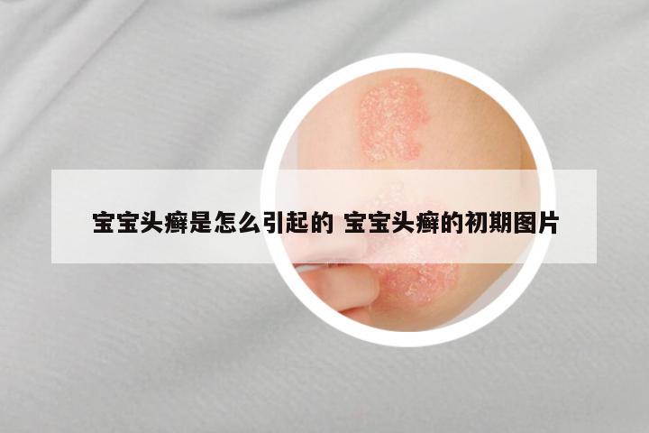 宝宝头癣是怎么引起的 宝宝头癣的初期图片