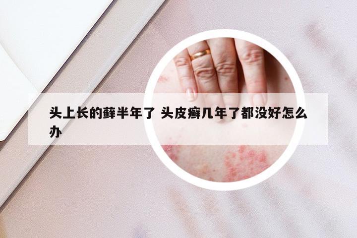 头上长的藓半年了 头皮癣几年了都没好怎么办