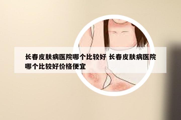 长春皮肤病医院哪个比较好 长春皮肤病医院哪个比较好价格便宜