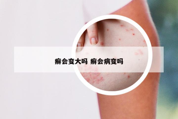 癣会变大吗 癣会病变吗