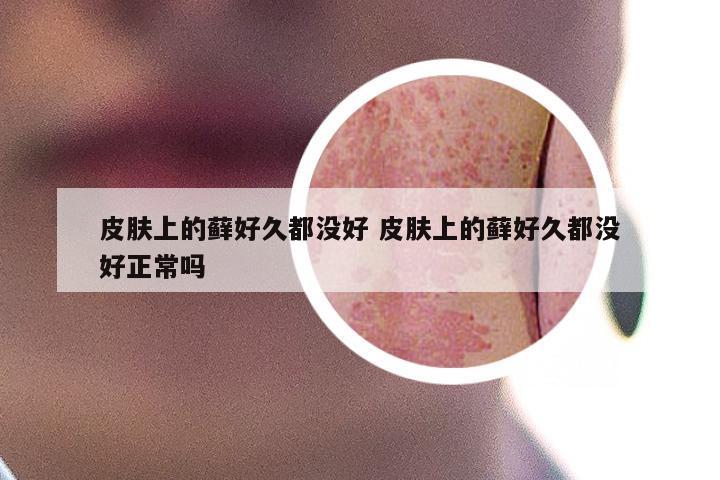 皮肤上的藓好久都没好 皮肤上的藓好久都没好正常吗